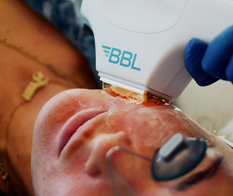 bbl hero tool being used on patient's face