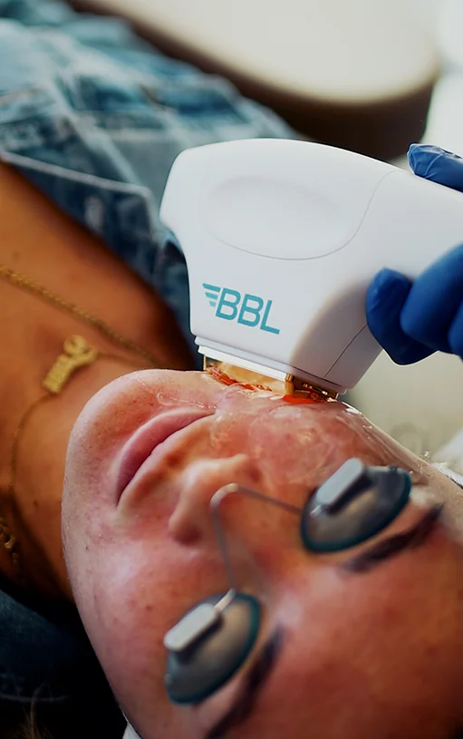 bbl hero tool being used on patient's face