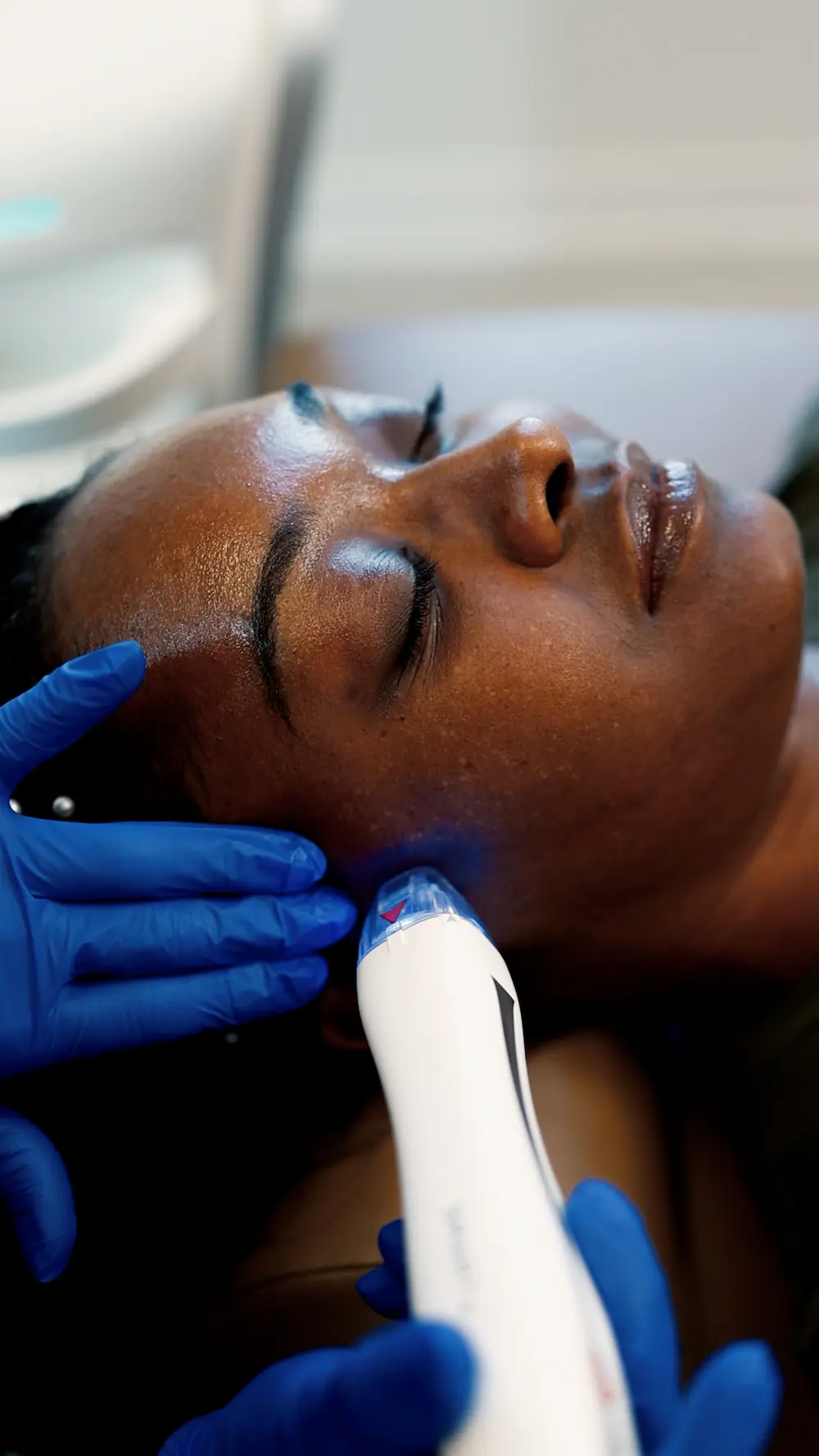 Woman getting Microneedling + Rf treatment at myEvergreen