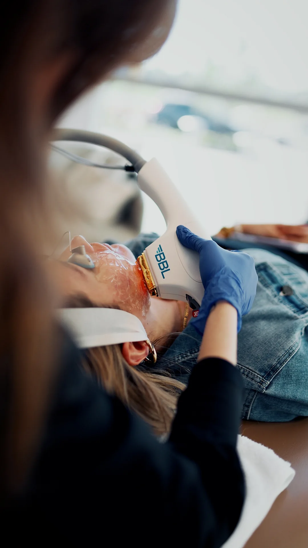 bbl laser being used on male face