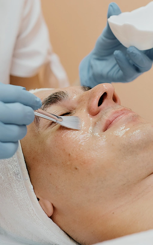 chemical peel treatment on man