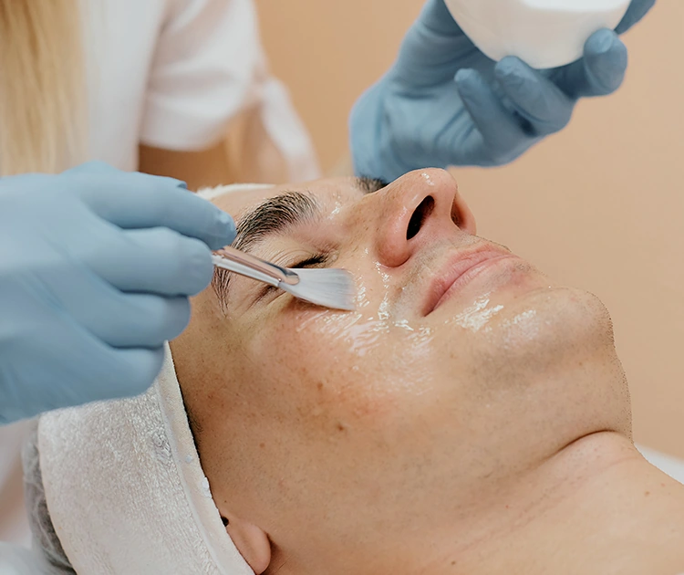 chemical peel treatment on man