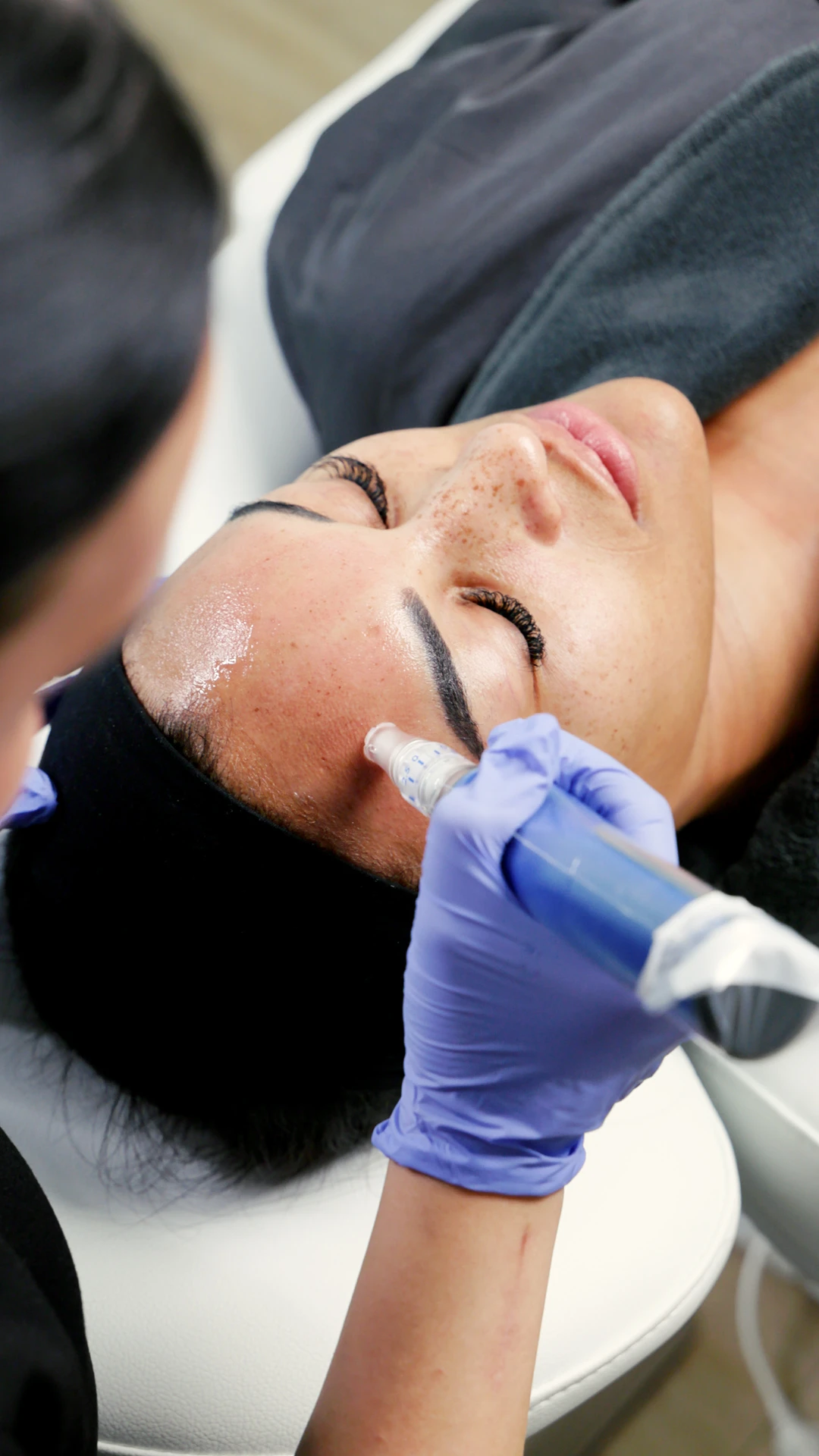 microneedling natural vamp