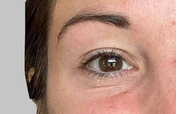 Case # 1 after photo