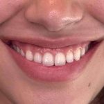 Botox/Dysport Before & After Patient #828