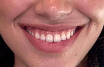 Botox/Dysport Before & After Patient #828