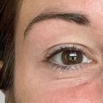 Botox/Dysport Before & After Patient #859