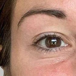 Botox/Dysport Before & After Patient #859