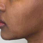 Full Facial Balancing Before & After Patient #862
