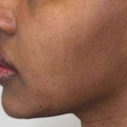 Full Facial Balancing Before & After Patient #862
