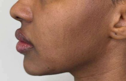 Full Facial Balancing Before & After Patient #862