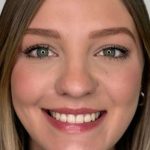 Full Facial Balancing Before & After Patient #865