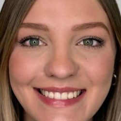 Full Facial Balancing Before & After Patient #865