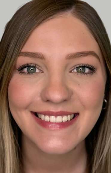 Full Facial Balancing Before & After Patient #865