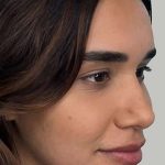 Full Facial Balancing Before & After Patient #868