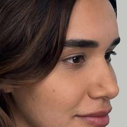 Full Facial Balancing Before & After Patient #868