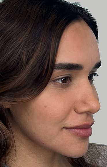 Full Facial Balancing Before & After Patient #868