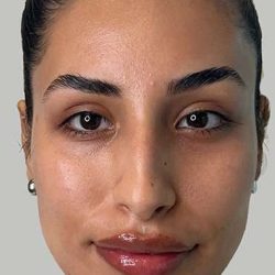 Full Facial Balancing Before & After Patient #871