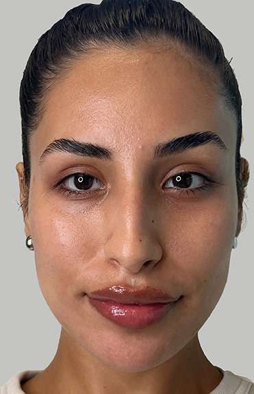 Full Facial Balancing Before & After Patient #871