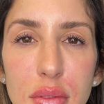 Full Facial Balancing Before & After Patient #874