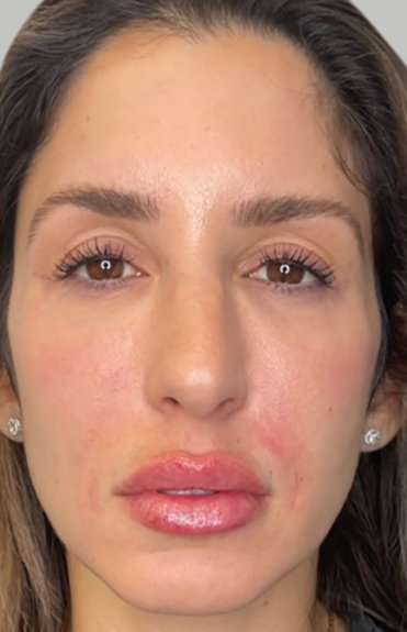 Full Facial Balancing Before & After Patient #874