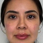 Full Facial Balancing Before & After Patient #877