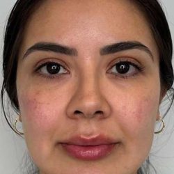 Full Facial Balancing Before & After Patient #877