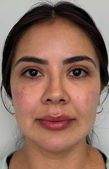 Full Facial Balancing Before & After Patient #877