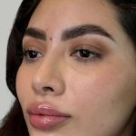 Full Facial Balancing Before & After Patient #880
