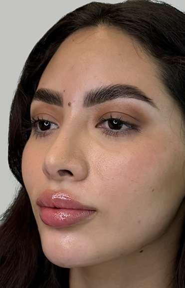 Full Facial Balancing Before & After Patient #880