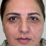 Full Facial Balancing Before & After Patient #883