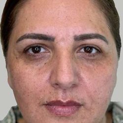 Full Facial Balancing Before & After Patient #883