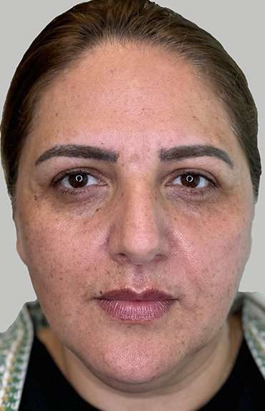 Full Facial Balancing Before & After Patient #883