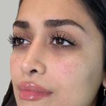 Full Facial Balancing Before & After Patient #886