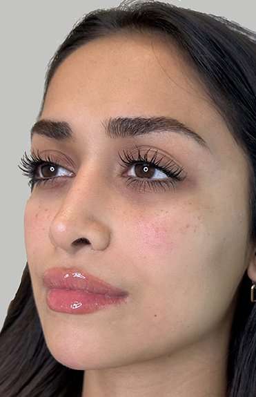 Full Facial Balancing Before & After Patient #886