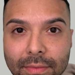 Botox/Dysport Before & After Patient #831