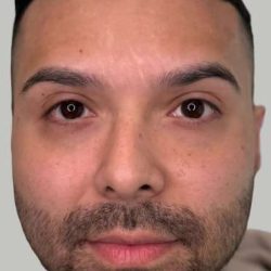 Botox/Dysport Before & After Patient #831