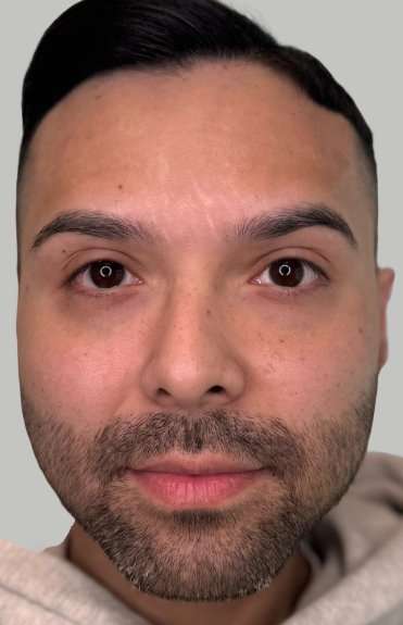 Botox/Dysport Before & After Patient #831