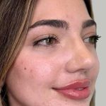 Full Facial Balancing Before & After Patient #889