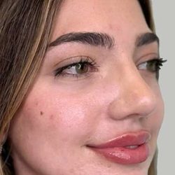 Full Facial Balancing Before & After Patient #889