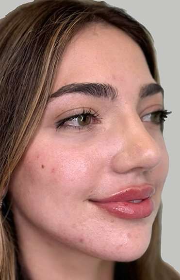 Full Facial Balancing Before & After Patient #889
