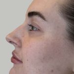 Full Facial Balancing Before & After Patient #892