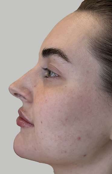 Full Facial Balancing Before & After Patient #892
