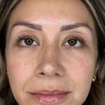Full Facial Balancing Before & After Patient #895