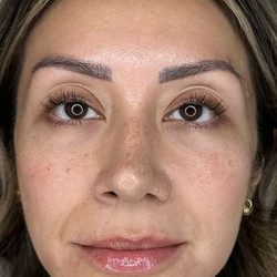 Full Facial Balancing Before & After Patient #895