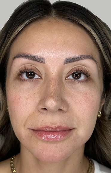 Full Facial Balancing Before & After Patient #895