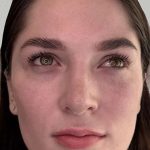 Full Facial Balancing Before & After Patient #898