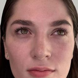 Full Facial Balancing Before & After Patient #898