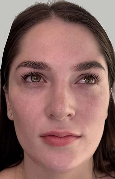 Full Facial Balancing Before & After Patient #898