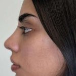 Full Facial Balancing Before & After Patient #901